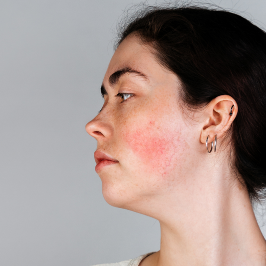What is Rosacea: Causes, Symptoms, and Best Treatment Options
