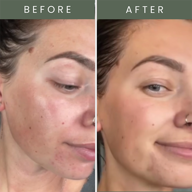 Before and after photo of skin after using pure kakadu plum vitamin c serum with brighter skin 