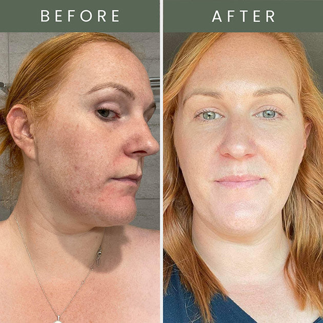 Before and after image of lady with red hair showing clear and brighter skin in after photo