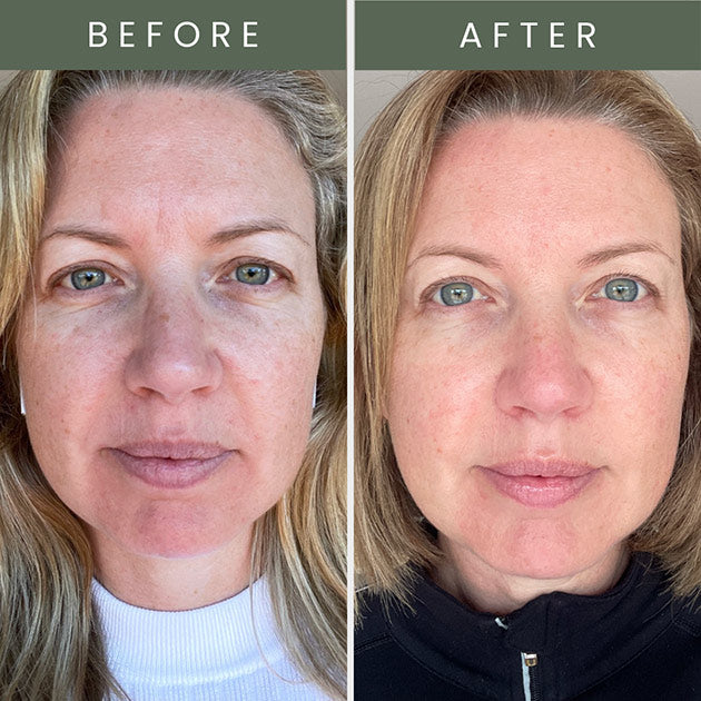 Before and after image of lady with blonde hair showing clear and brighter skin in after photo