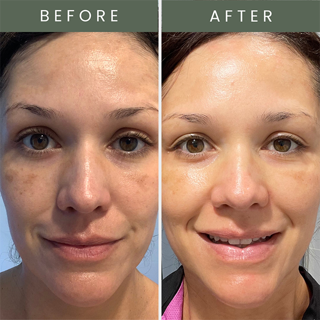 Before and after photo of skin after using pure kakadu plum vitamin c serum with brighter skin 