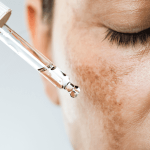 Treating Pigmentation